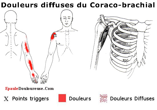 douleur au bras 