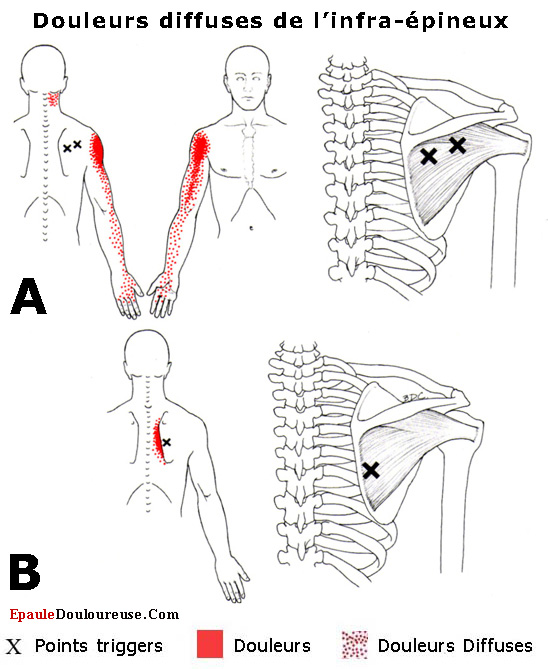 douleur épaule gauche