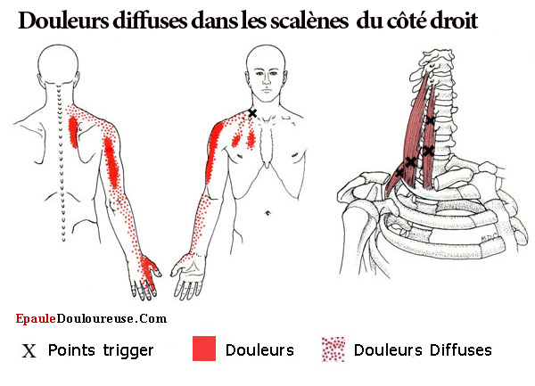 syndrome du canal carpien