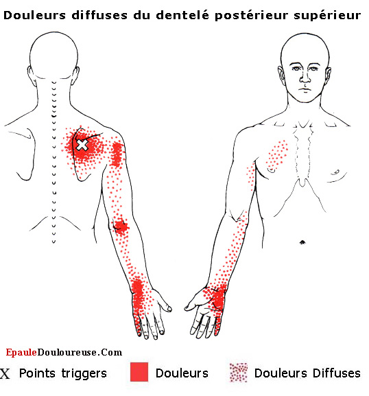 douleur dans le haut du dos