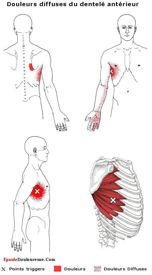 Douleur sur le côté lorsque vous prenez une grande respiration