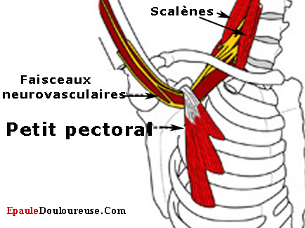 points trigger dans le petit pectoral