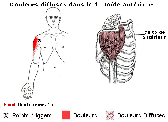 prudence points gâchettes