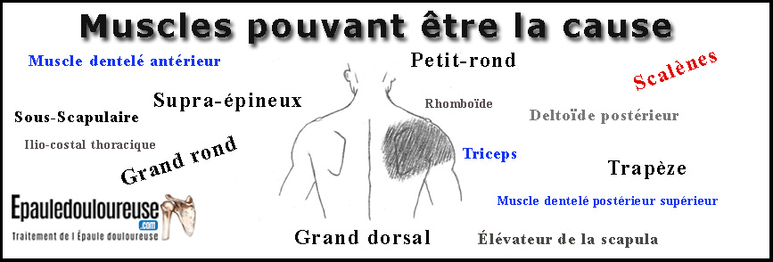 douleur dessus épaule