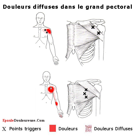 douleur angine poitrine
