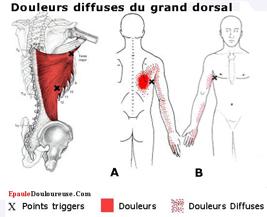douleur dos