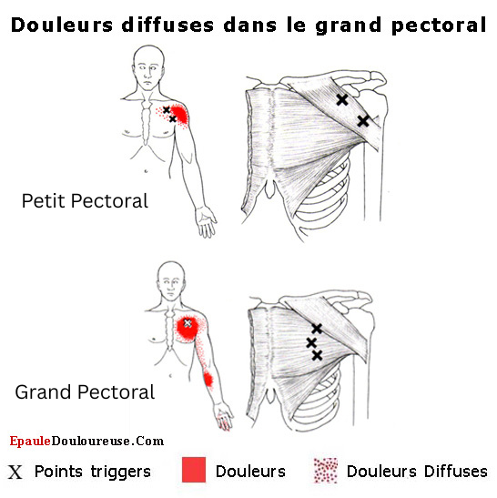 douleur angine poitrine