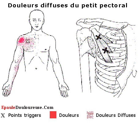 points trigger dans le petit pectoral