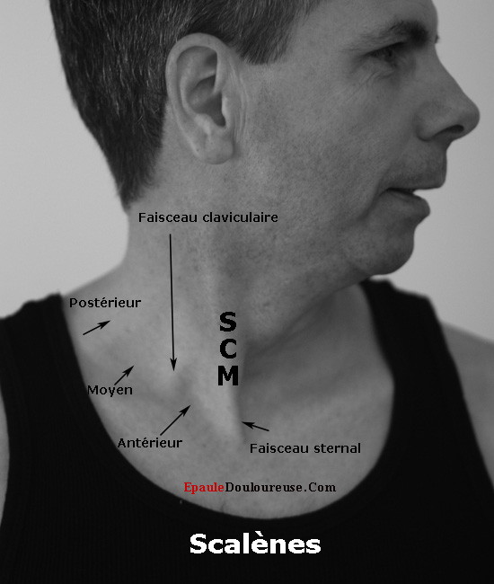 syndrome du canal carpien