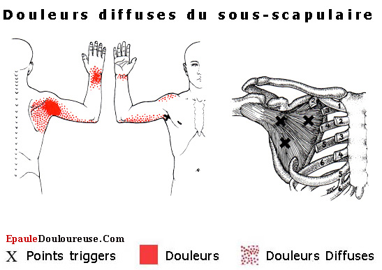 douleur épaule gelée