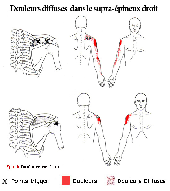douleur deltoide