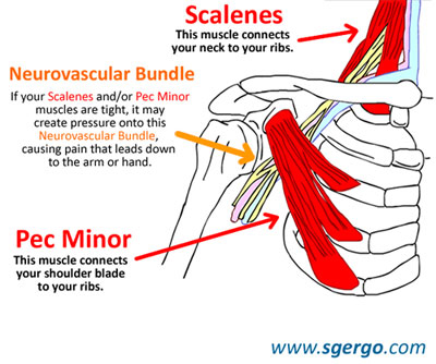 syndrome du canal carpien