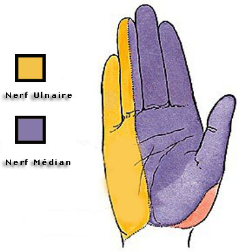 syndrome du canal carpien