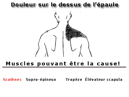 douleur sur le dessus de l'épaule