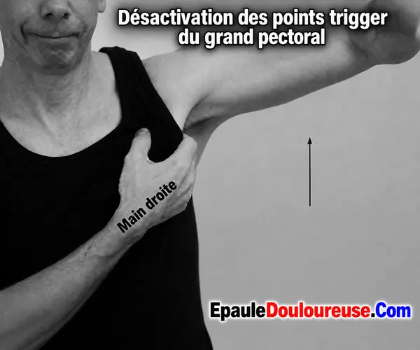 Repérage des points trigger du grand pectoral