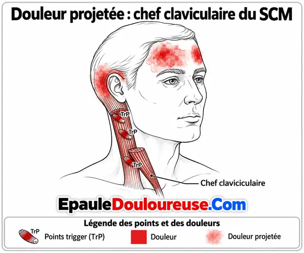 Points trigger du chef claviculaire du SCM et douleur projetée