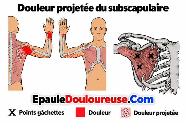 Points gâchettes du sous-scapulaire et zones possibles de douleur projetée
