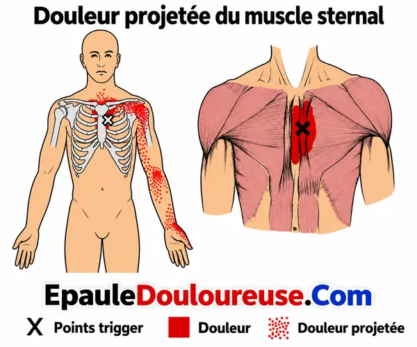 Zone de douleur projetée du muscle sternal