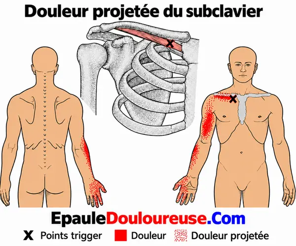 Zone de douleur projetée du subclavier