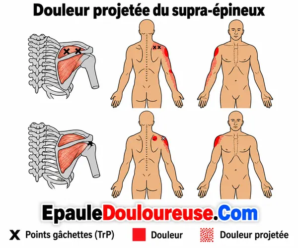 Points trigger du supra-épineux et zones possibles de douleur projetée