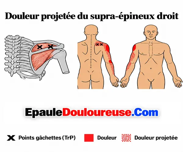 Zone de douleur projetée du supra-épineux