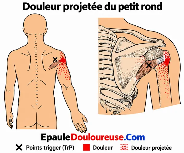 Schéma de douleur référée du petit rond
