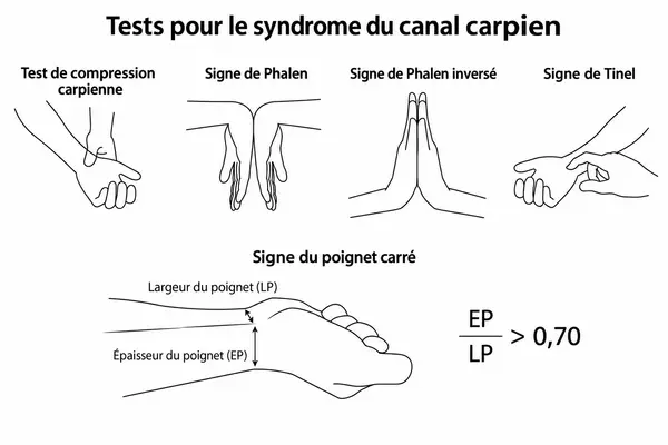 Manœuvres de Phalen, de Phalen inversée et de compression du
           poignet utilisées lors d’un examen physique du canal carpien