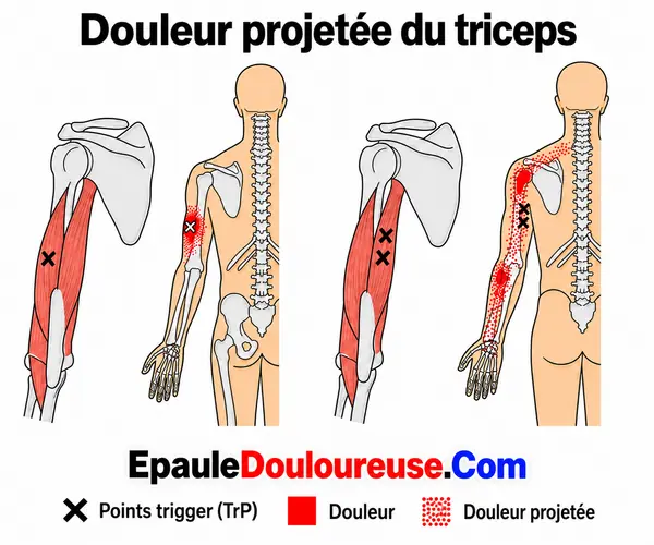 Schéma de douleur référée du triceps brachial